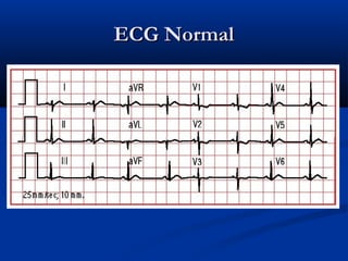 ECG NormalECG Normal
 