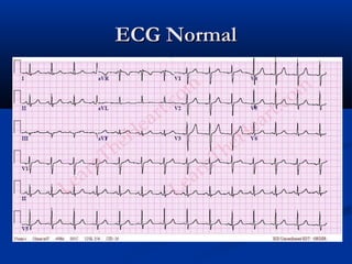 ECG NormalECG Normal
 