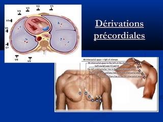 DérivationsDérivations
précordialesprécordiales
 