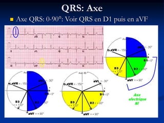 QRS: Axe
 Axe QRS: 0-90°: Voir QRS en D1 puis en aVF
 