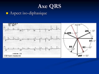 Axe QRS
 Aspect iso-diphasique
 