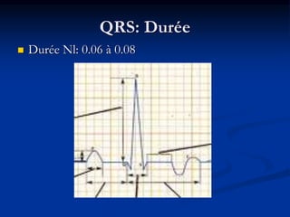 QRS: Durée
 Durée Nl: 0.06 à 0.08
 