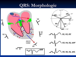 QRS: Morphologie
 