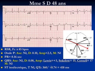 Mme S D 48 ans
 RSR, Fc à 85 bpm
 Onde P: Axe: Nl, D: 0.10, Amp<2.5, M: Nl
 PR= 0.16 sec
 QRS: Axe: Nl, D: 0.08, Amp: Lewis=+3, Sokolow= 15, Cornell= 17
M: Nl
 ST isoélectrique, T Nl, QTc 360/ √0.74 = 418 ms
 