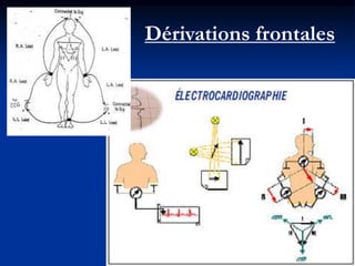 Dérivations frontales
 