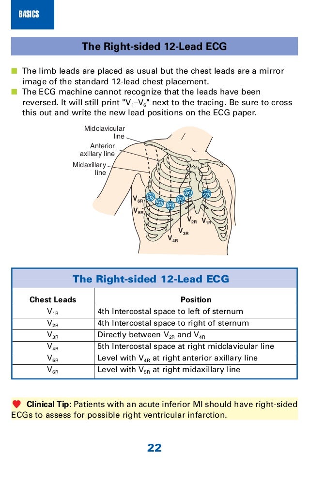 42+ V4R Lead Placement Pics
