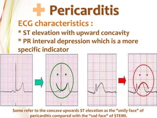 Pericarditis
ECG characteristics :
* ST elevation with upward concavity
* PR interval depression which is a more
specific indicator
Some refer to the concave upwards ST elevation as the "smily face" of
pericarditis compared with the “sad face" of STEMI.
 