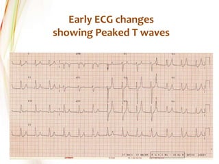 Early ECG changes
showing Peaked T waves
 