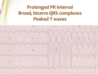 Prolonged PR interval
Broad, bizarre QRS complexes
Peaked T waves
 