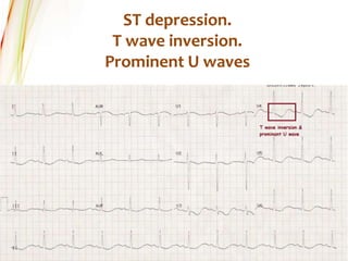 ST depression.
T wave inversion.
Prominent U waves
 