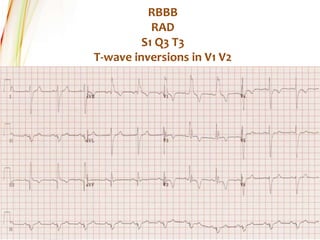 RBBB
RAD
S1 Q3 T3
T-wave inversions in V1 V2
 