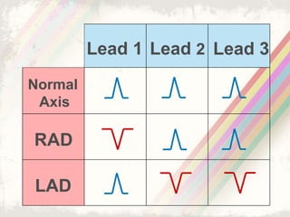 Normal
Axis
RAD
LAD
Lead 1 Lead 2 Lead 3
 