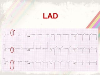 LAD
 