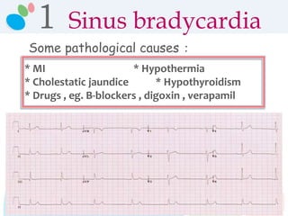 Some pathological causes :
* MI * Hypothermia
* Cholestatic jaundice * Hypothyroidism
* Drugs , eg. B-blockers , digoxin , verapamil
1 Sinus bradycardia
 