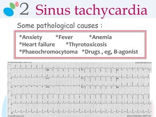 *Anxiety *Fever *Anemia
*Heart failure *Thyrotoxicosis
*Phaeochromocytoma *Drugs , eg, B-agonist
Some pathological causes :
2 Sinus tachycardia
 