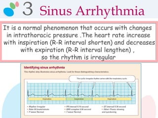 3 Sinus Arrhythmia
It is a normal phenomenon that occurs with changes
in intrathoracic pressure .The heart rate increase
with inspiration (R-R interval shorten) and decreases
with expiration (R-R interval lengthen) ,
so the rhythm is irregular
 
