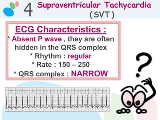 Supraventricular Tachycardia
(SVT )
ECG Characteristics :
* Absent P wave , they are often
hidden in the QRS complex
* Rhythm : regular
* Rate : 150 – 250
* QRS complex : NARROW
4
 