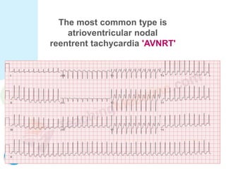 The most common type is
atrioventricular nodal
reentrent tachycardia 'AVNRT'
 