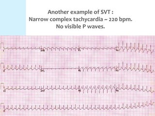 Another example of SVT :
Narrow complex tachycardia ~ 220 bpm.
No visible P waves.
 