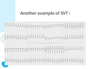 Another example of SVT :
 