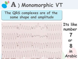 A ) Monomorphic VT
The QRS complexes are of the
same shape and amplitude
Its like
number
7
or
8
in
Arabic
 