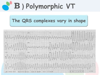 B ) Polymorphic VT
The QRS complexes vary in shape
 