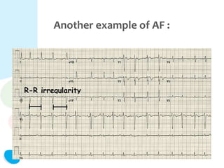Another example of AF :
 