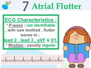 7 Atrial Flutter
ECG Characteristics :
* P-wave : not identifiable
, with saw toothed , flutter
waves In :
lead 2 , lead 3 , aVF & V1.
* Rhythm : usually regular
 