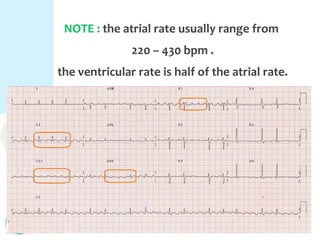NOTE : the atrial rate usually range from
220 – 430 bpm .
the ventricular rate is half of the atrial rate.
 