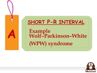 A
SHORT P-R INTERVAL
Example
Wolf–Parkinson–White
(WPW) syndrome
 