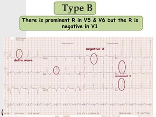 Type B
There is prominent R in V5 & V6 but the R is
negative in V1
 
