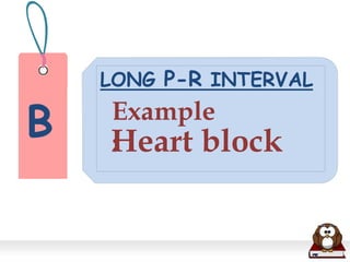 B
LONG P-R INTERVAL
Example
:Heart block
 