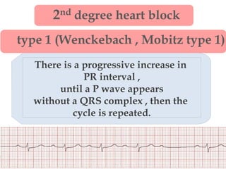2nd degree heart block
type 1 (Wenckebach , Mobitz type 1)
There is a progressive increase in
PR interval ,
until a P wave appears
without a QRS complex , then the
cycle is repeated.
 