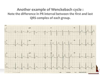 Another example of Wenckebach cycle :
Note the difference in PR interval between the first and last
QRS complex of each group.
 