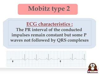 Mobitz type 2
ECG characteristics :
The PR interval of the conducted
impulses remain constant but some P
waves not followed by QRS complexes
 
