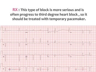 RX : This type of block is more serious and is
often progress to third degree heart block , so it
should be treated with temporary pacemaker.
 