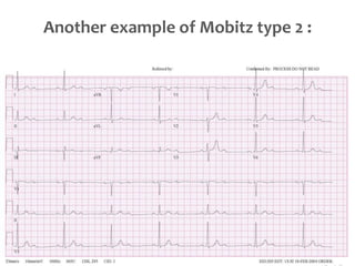 Another example of Mobitz type 2 :
 