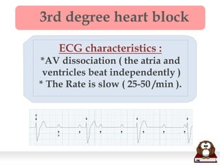 3rd degree heart block
ECG characteristics :
*AV dissociation ( the atria and
ventricles beat independently )
* The Rate is slow ( 25-50 /min ).
 