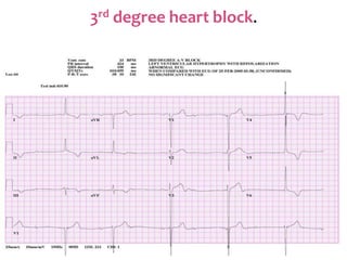3rd degree heart block.
 