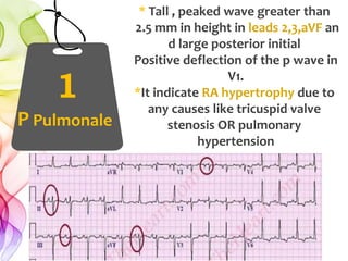 1
P Pulmonale
* Tall , peaked wave greater than
2.5 mm in height in leads 2,3,aVF an
d large posterior initial
Positive deflection of the p wave in
V1.
*It indicate RA hypertrophy due to
any causes like tricuspid valve
stenosis OR pulmonary
hypertension
 