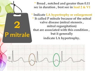 2
P mitrale
＊Broad , notched and greater than 0.11
sec in duration , best see in lead 2 & V1
* Indicate LA hypertrophy or enlargement
＊It called P mitrale because of the mitral
valve disease (mitral stenosis ,
mitral regurgitation)
that are associated with this condition ,
but it generally
indicate LA hypertrophy.
 