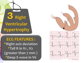ECG FEATURES :
*Right axis deviation
*Tall R in V1 , V2
(greater than 7 mm )
*Deep S wave in V6
3 Right
Ventricular
Hypertrophy
 