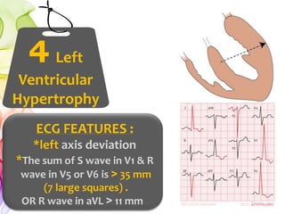 ECG FEATURES :
*left axis deviation
*The sum of S wave in V1 & R
wave in V5 or V6 is ˃ 35 mm
(7 large squares) .
OR R wave in aVL ˃ 11 mm
4 Left
Ventricular
Hypertrophy
 