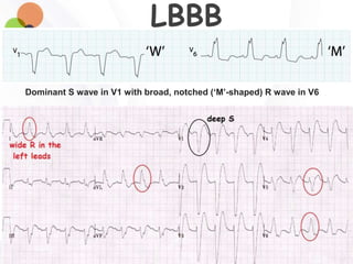 LBBB
Dominant S wave in V1 with broad, notched (‘M’-shaped) R wave in V6
 