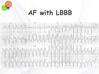 AF with LBBB
 