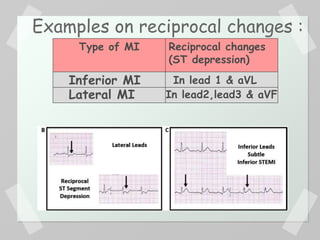 Examples on reciprocal changes :
Reciprocal changes
(ST depression)
Type of MI
In lead 1 & aVLInferior MI
Lateral MI In lead2,lead3 & aVF
 