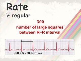 Rate
 regular
𝟑𝟎𝟎
number of large squares
between R−R interval
 