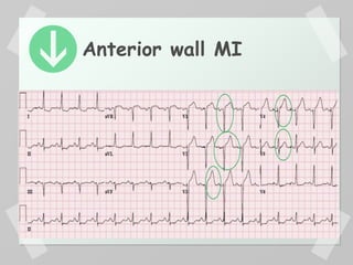 Anterior wall MI
 