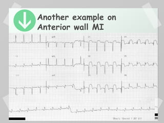 Another example on
Anterior wall MI
 