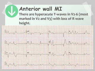 Anterior wall MI
There are hyperacute T-waves in V2-6 (most
marked in V2 and V3) with loss of R wave
height.
 